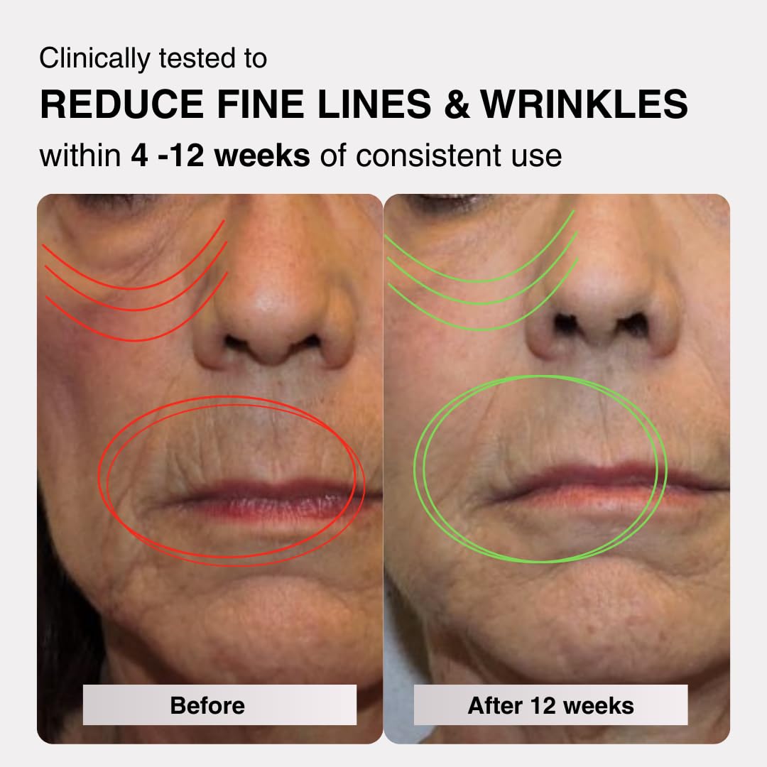 VogueNow LuminX Pro FDA-Cleared LED Light Therapy Mask – Red, Blue & Infrared Light for Wrinkle Reduction, Acne Treatment - Lip & Jowl Coverage (RB-008G)