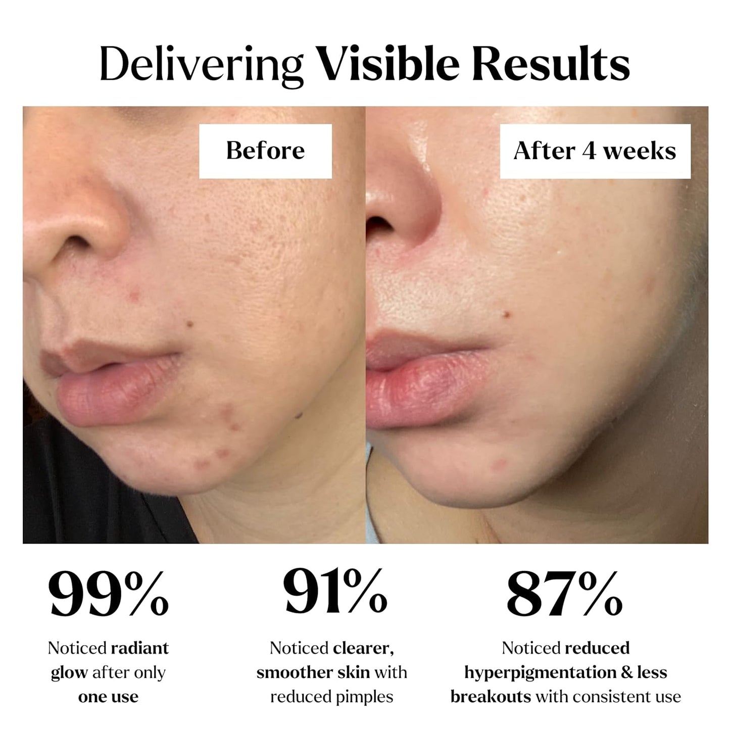 VogueNow Clay Mask Gift Pack of 4 Jars (400g) With Cute Headband & Brush | Premium Clay Face Mask | Turmeric Vitamin C, Green Tea, Rose, Dead Sea Mud | Clay Mask For Face | Spa Gift set for Women